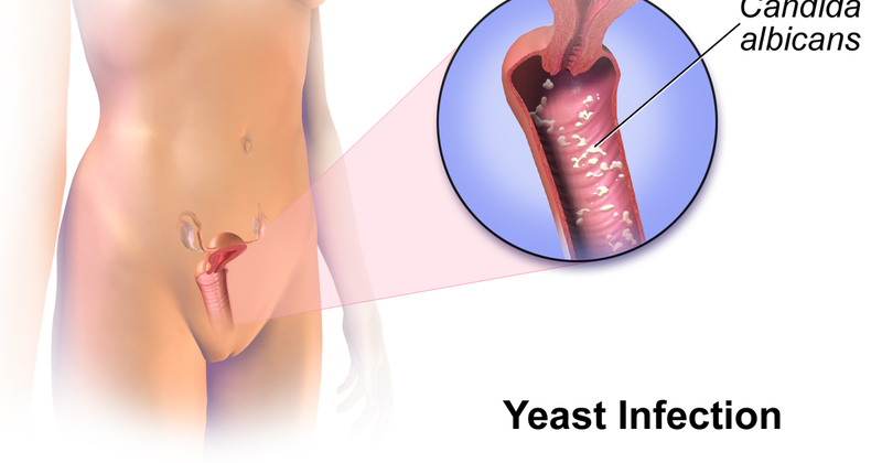 yeast infections 