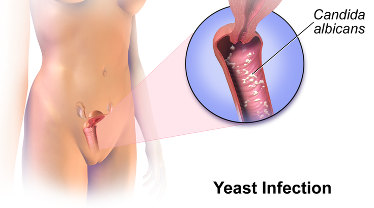 Yeast Infections Symptoms Treatment Prevention