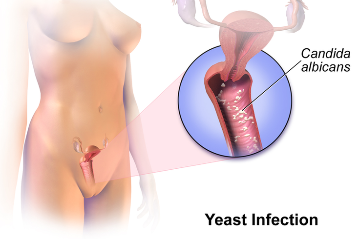 Women With Diabetes At Risk For Recurrent Yeast Infections