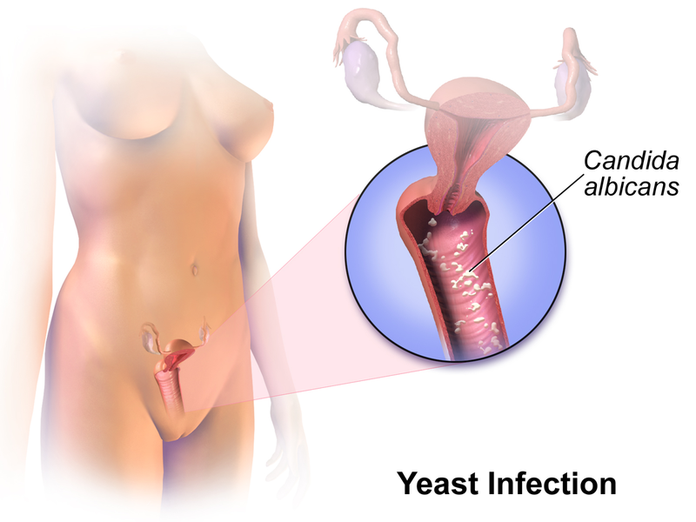 Women With Diabetes At Risk For Recurrent Yeast Infections