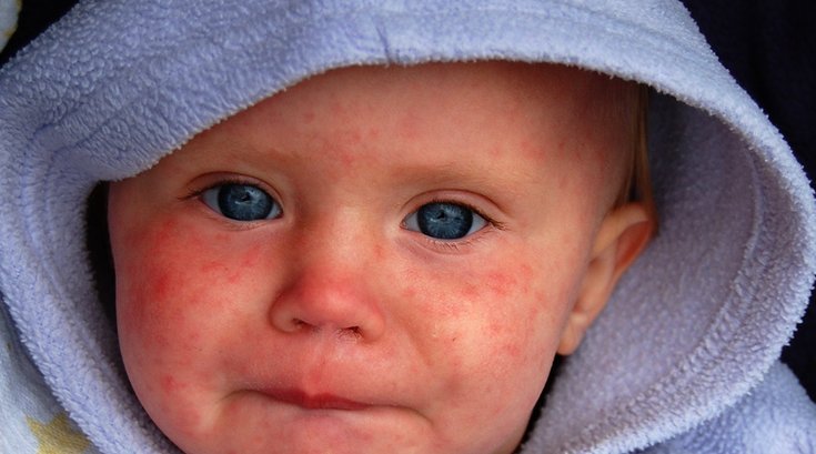 02012019_measles_flickr