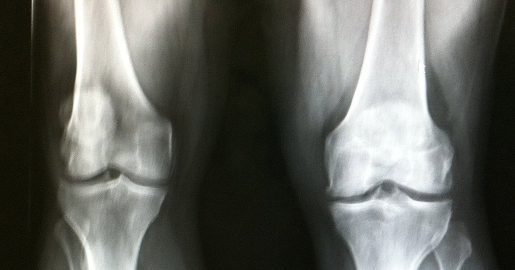 Stem Cell Treatments For Arthritic Knees Are Unproven Expensive And