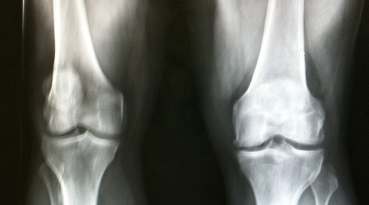 02052019_knees_xray_flickr