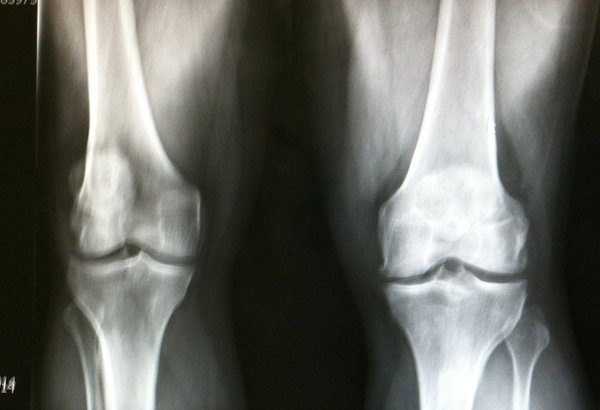02052019_knees_xray_flickr