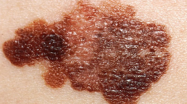 02252019_Melanoma_wiki