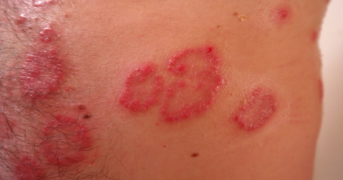 is psoriasis painful or itchy