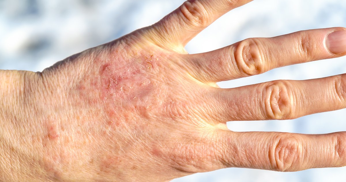 Eczema treatments Experimental drug lebrikizumab provides 'rapid