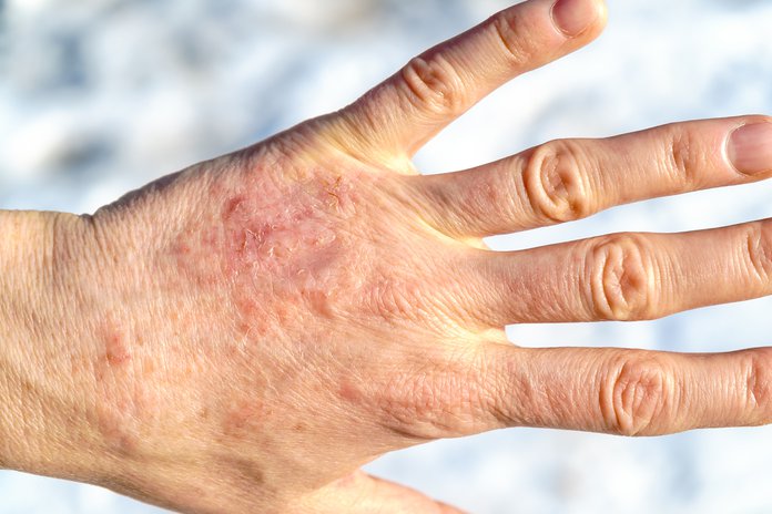 Eczema and Dry Skin: 5 Tips to Help Kids This Winter > News > Yale Medicine