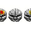 Brain Electrostimulation Boston University 04092019