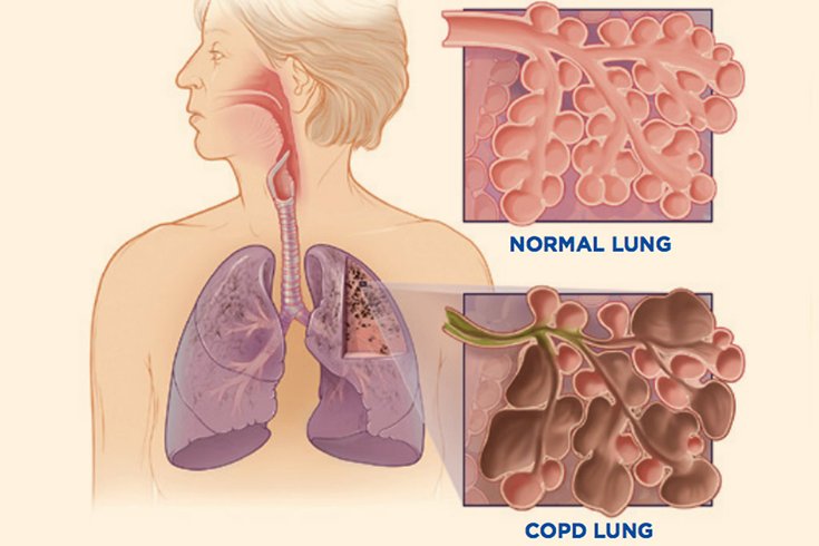 04162018_COPD_CDC