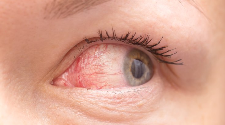 COVID-19 Pink Eye