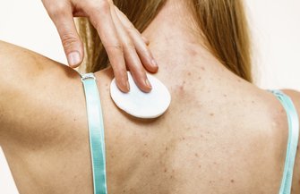 Acne Eating Disorders