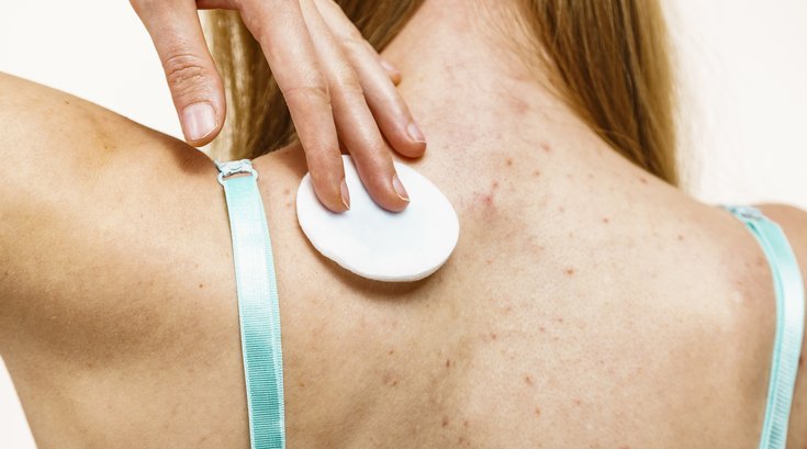 Acne Eating Disorders