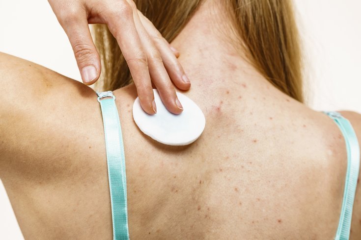 Acne Eating Disorders