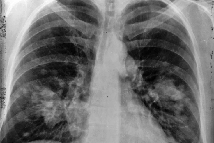 05032015_lung_cancer_wiki