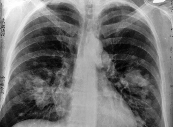 05032015_lung_cancer_wiki