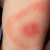 Lyme Disease Bullseye Rash 05142019
