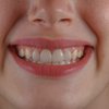 Fluoride Tablets Drops Ban