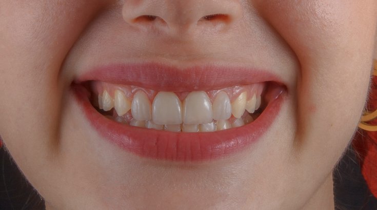 Fluoride Tablets Drops Ban