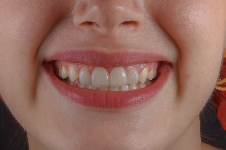 Fluoride Tablets Drops Ban