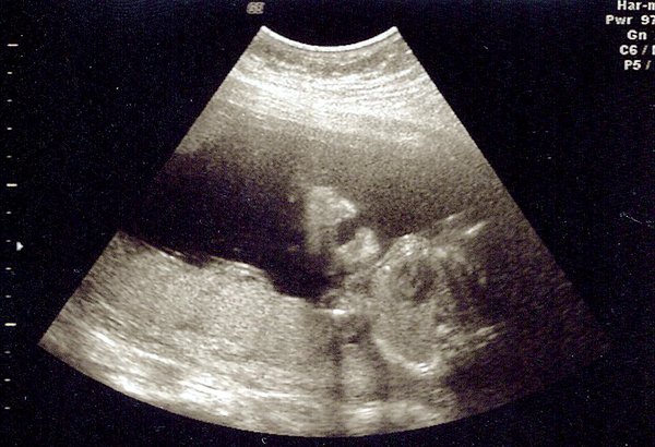 Sonogram 05162019