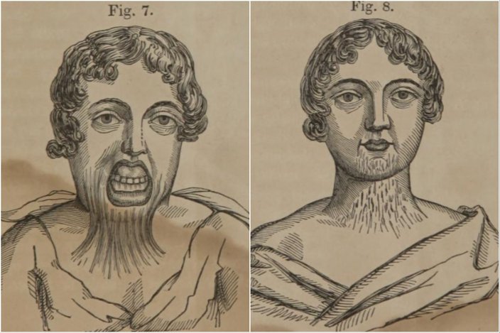 Illustration of a 9-year-old patient before and after Mütter flap surgery