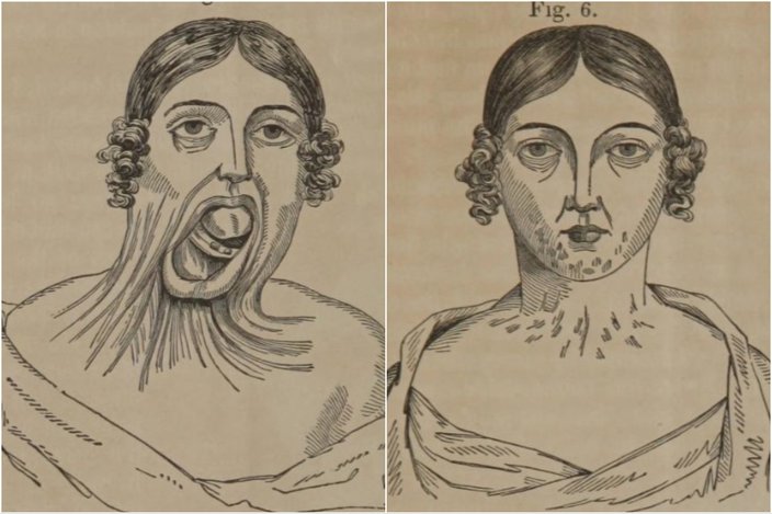 Illustration of a 12-year-old patient before and after Mütter flap surgery