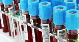 Alzheimer's Blood Test