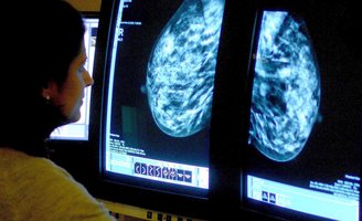 Dense Breasts Cancer Screening