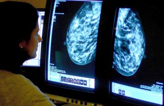 Dense Breasts Cancer Screening