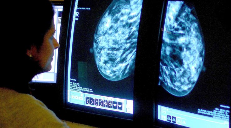 Dense Breasts Cancer Screening