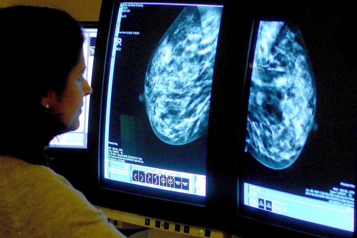 Dense Breasts Cancer Screening