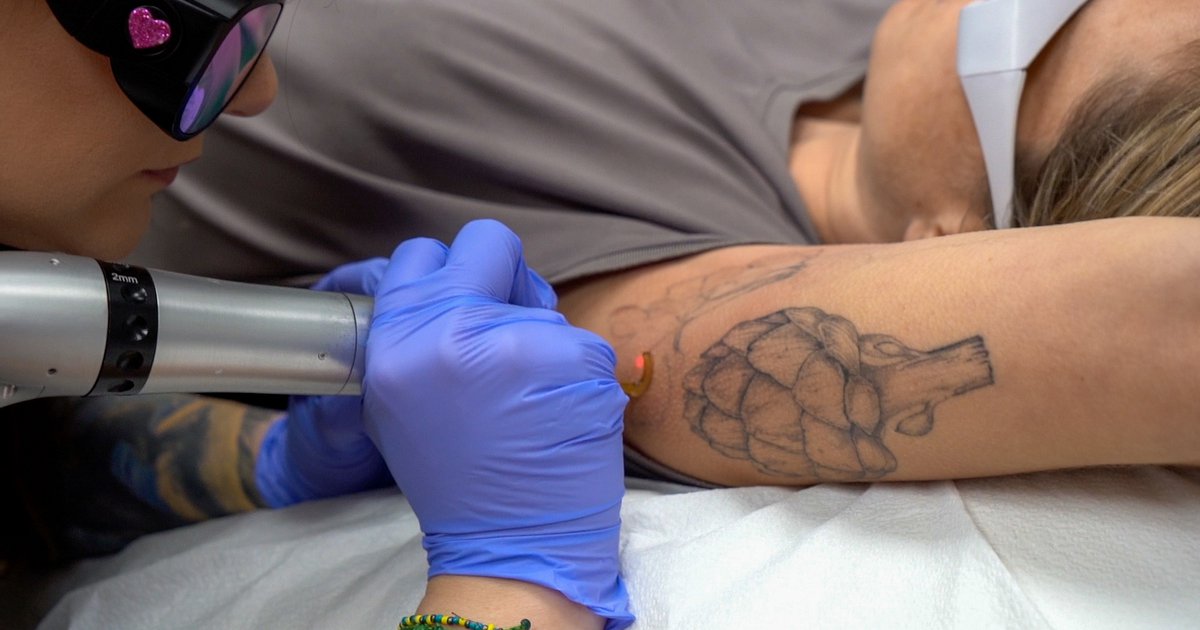 Can Lasers Make Your Tattoo Disappear Completely  Synergy Wellness