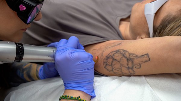 Tattoo Removal in Aberdeen | Tattoo Removal Near Me