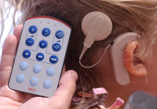 Cochlear implants