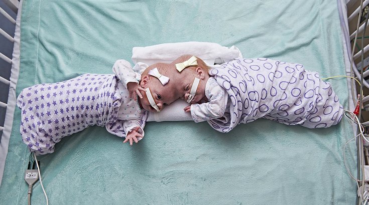 06132017_CHOP_cojoined_twins