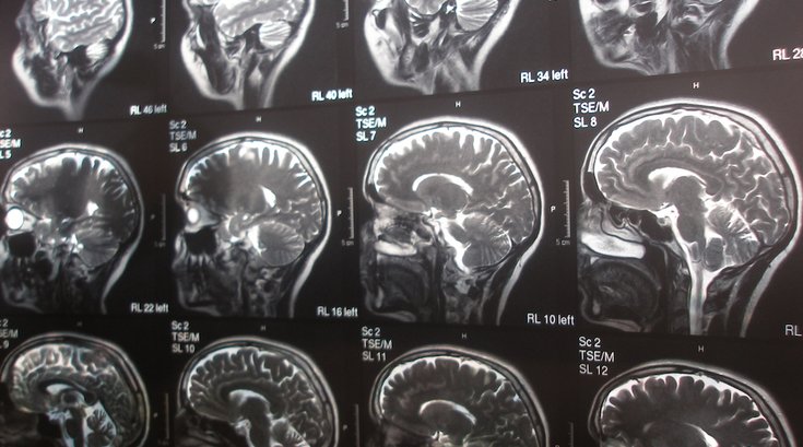 blood pressure drug alzheimers treatmetn 