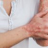 Food and skin inflammation