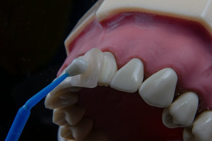 Veneers Teeth