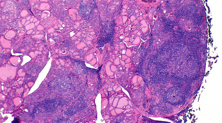 Hashimoto_thyroiditis 07112019