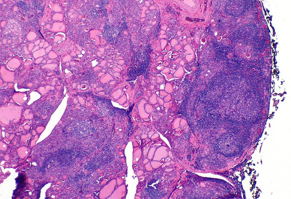 Hashimoto_thyroiditis 07112019