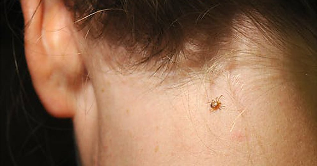 tick bite pictures on humans