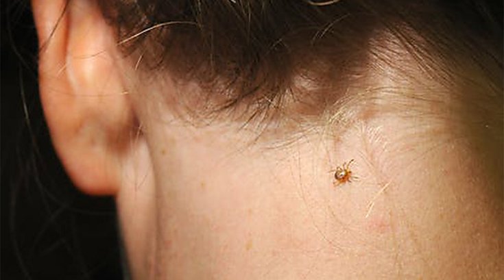 Tick On Neck MSU 071412019