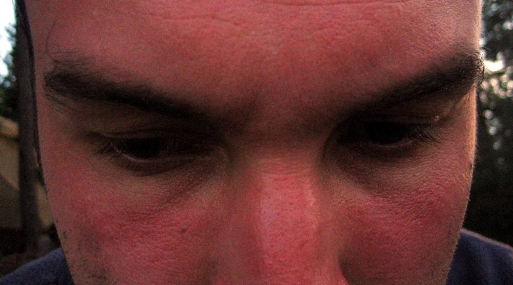 Sunburn Bad 07152019