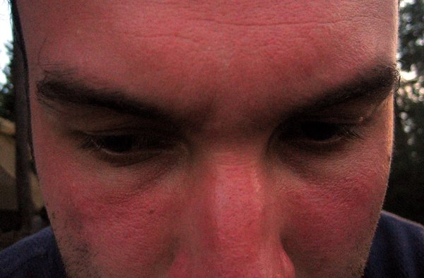 Sunburn Bad 07152019
