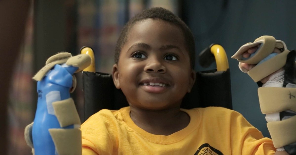 Doctors at CHOP perform world's first bilateral hand transplant on ...