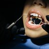 Cavities Tooth Decay