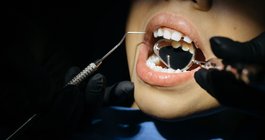 Cavities Tooth Decay
