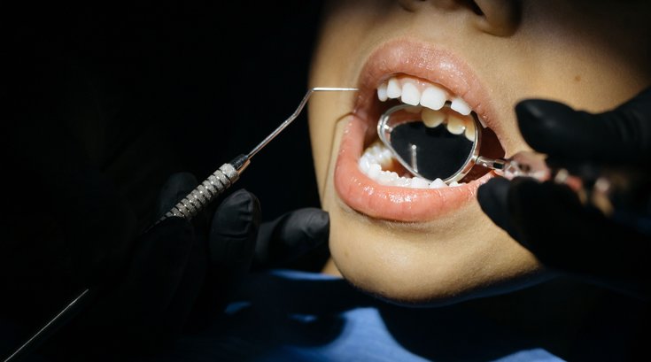 Cavities Tooth Decay