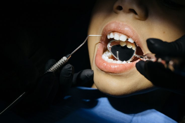 Cavities Tooth Decay